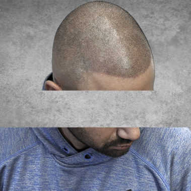 Micropigmentation Gallery Case Studies, Gallery