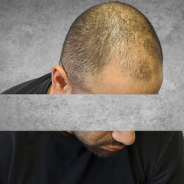 Micropigmentation Gallery Case Studies, Gallery