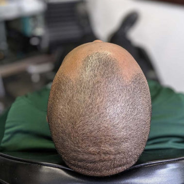 Micropigmentation Gallery Case Studies, Gallery