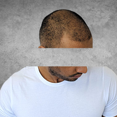 Micropigmentation Gallery Case Studies, Gallery