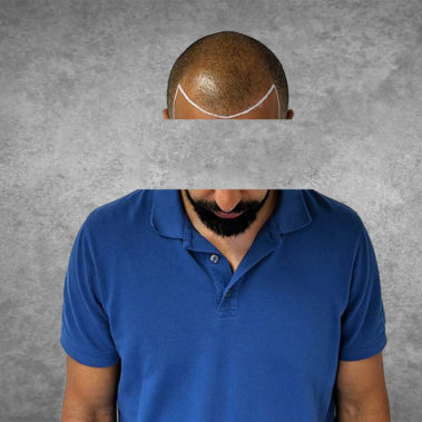 Micropigmentation Gallery Case Studies, Gallery