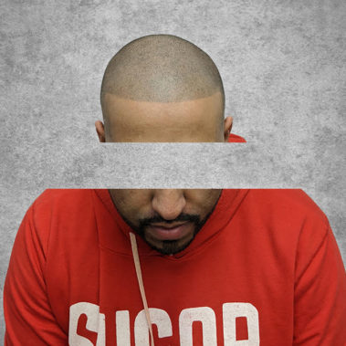 Micropigmentation Gallery Case Studies, Gallery