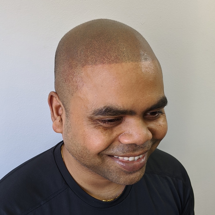 Scalp Micropigmentation, Full Scalp Micropigmentation