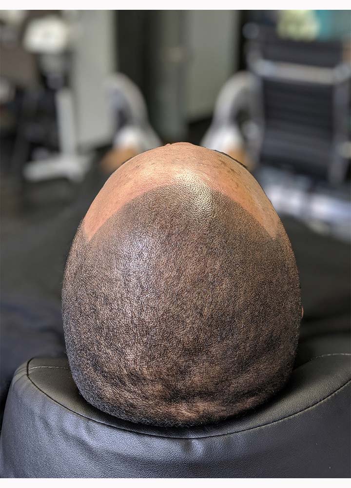 Scalp Micropigmentation, Scar Camouflage SMP