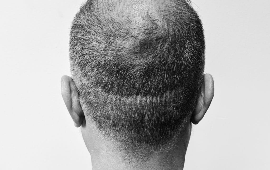 Scalp Micropigmentation, Scar Camouflage SMP