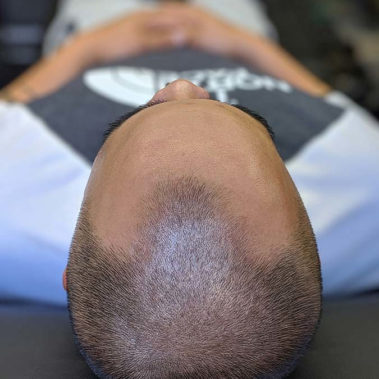 Micropigmentation Gallery Case Studies, Gallery