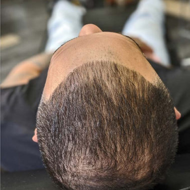 Micropigmentation Gallery Case Studies, Gallery