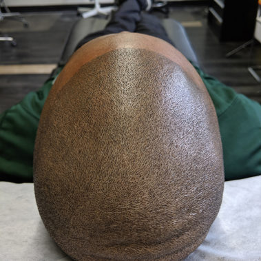 Micropigmentation Gallery Case Studies, Gallery