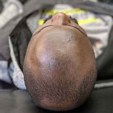 Micropigmentation Gallery Case Studies, Gallery