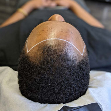 Micropigmentation Gallery Case Studies, Gallery