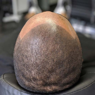 Micropigmentation Gallery Case Studies, Gallery