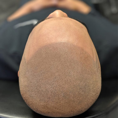 Micropigmentation Gallery Case Studies, Gallery