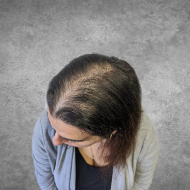 Micropigmentation Gallery Case Studies, Gallery