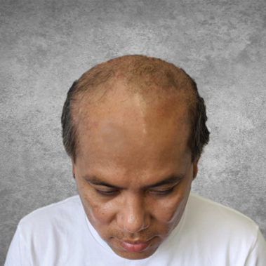 Micropigmentation Gallery Case Studies, Gallery