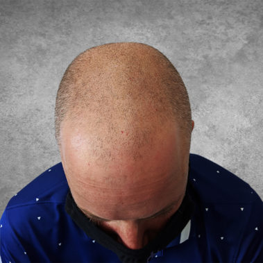 Micropigmentation Gallery Case Studies, Gallery