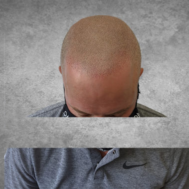 Micropigmentation Gallery Case Studies, Gallery