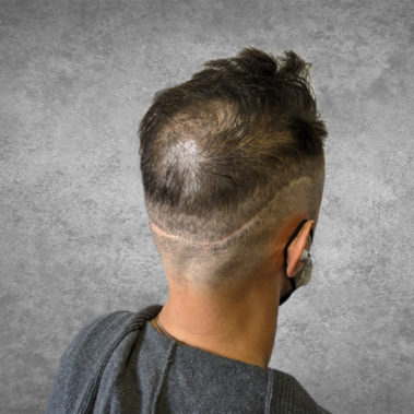 Micropigmentation Gallery Case Studies, Gallery