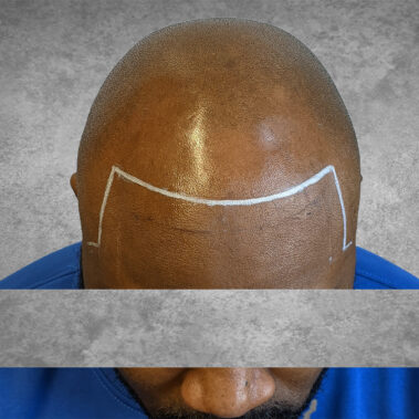 Micropigmentation Gallery Case Studies, Gallery