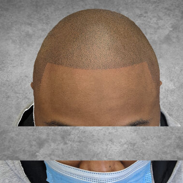 Micropigmentation Gallery Case Studies, Gallery