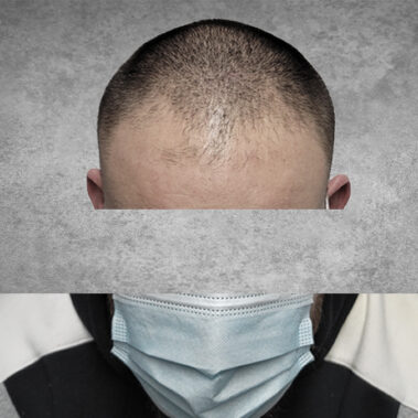 Micropigmentation Gallery Case Studies, Gallery