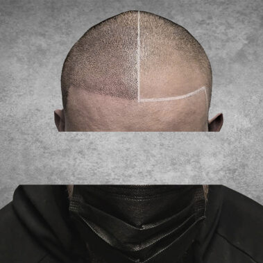 Micropigmentation Gallery Case Studies, Gallery