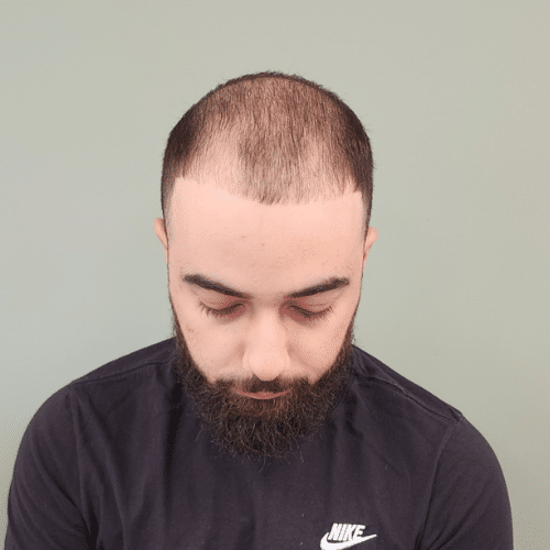 Shaved Look and Bald Hair, Brampton