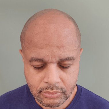 Micropigmentation Gallery Case Studies, Gallery