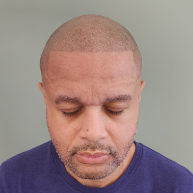 Micropigmentation Gallery Case Studies, Gallery