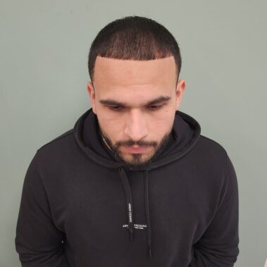 Micropigmentation Gallery Case Studies, Gallery