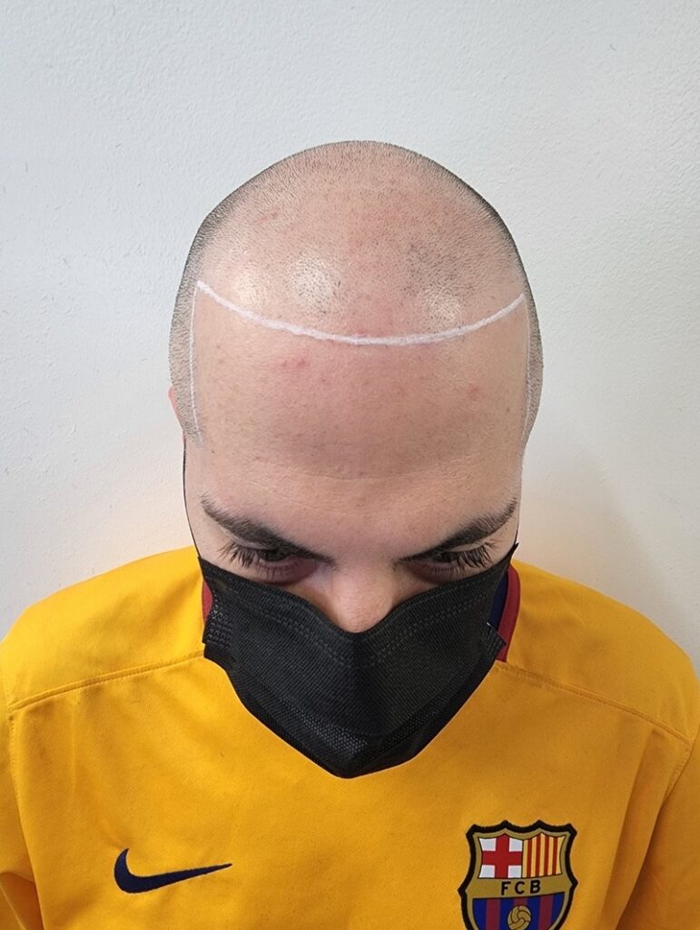 Scalp Micropigmentation, Soft Hairline SMP