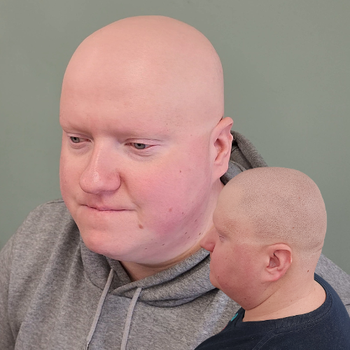 Scalp Micropigmentation, Alopecia Treatment SMP