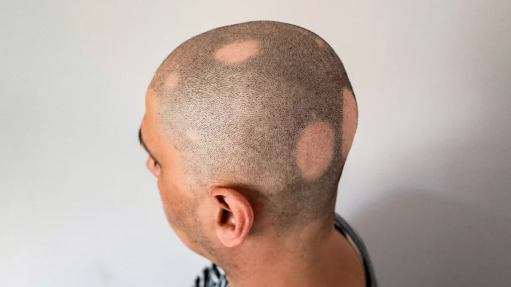 Scalp Micropigmentation, Alopecia Treatment SMP