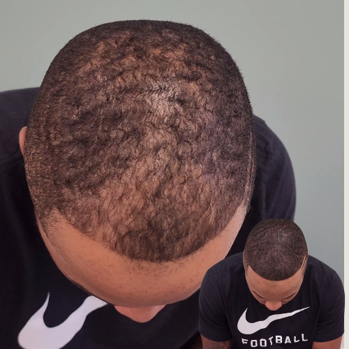 Scalp Micropigmentation, Density Enhancement SMP