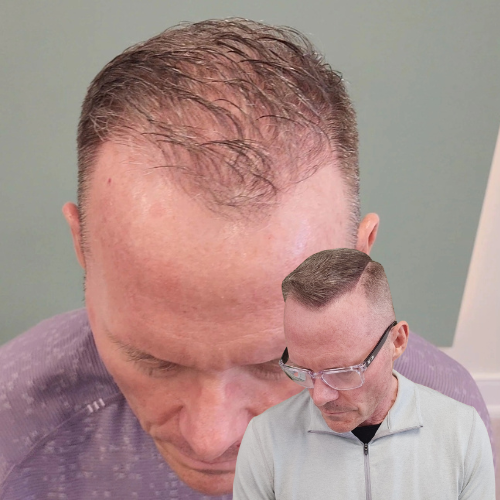 Scalp Micropigmentation, Density Enhancement SMP