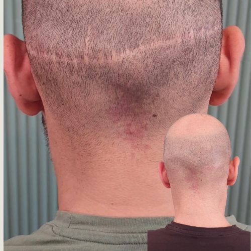 Scalp Micropigmentation, Scar Camouflage SMP