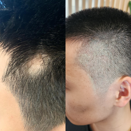 Scalp Micropigmentation, Alopecia Treatment SMP