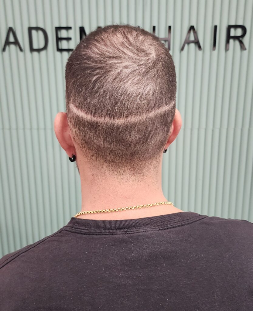 Scalp Micropigmentation, Scar Camouflage SMP