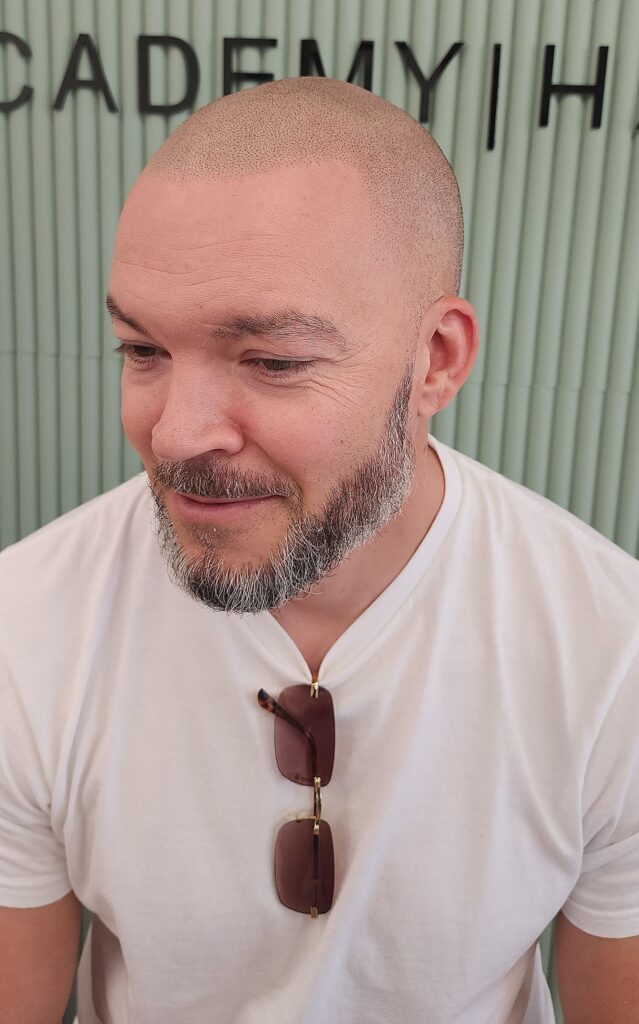 Scalp Micropigmentation, Soft Hairline SMP