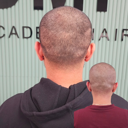 Scalp Micropigmentation, Scar Camouflage SMP