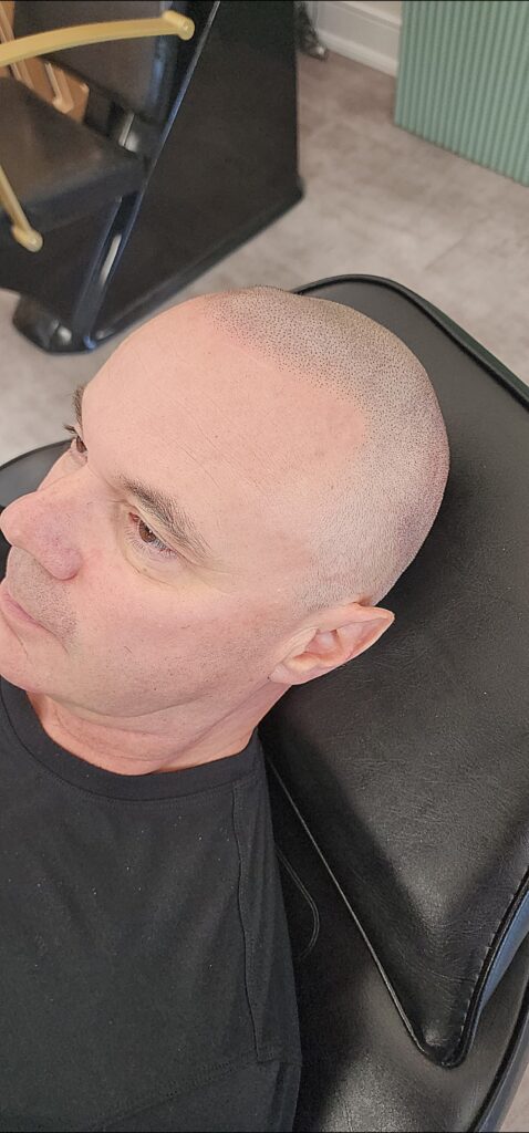 Scalp Micropigmentation, Soft Hairline SMP