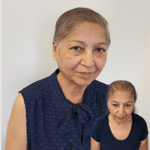 Scalp Micropigmentation, Female Scalp Micropigmentation