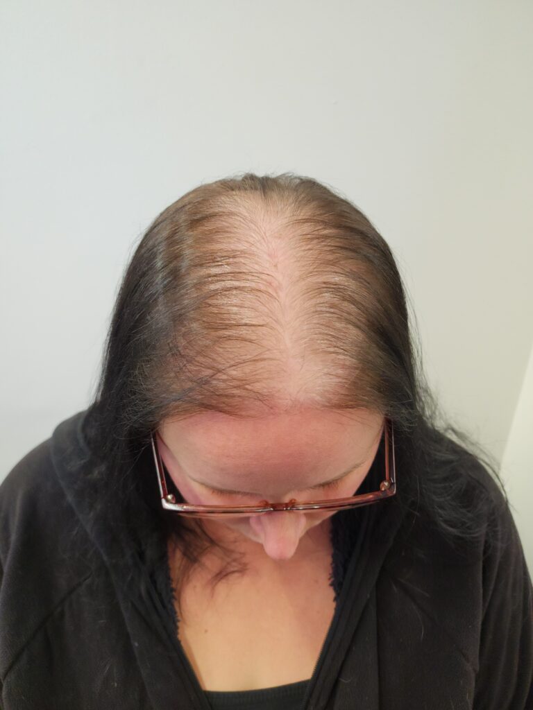 Scalp Micropigmentation, Female Scalp Micropigmentation