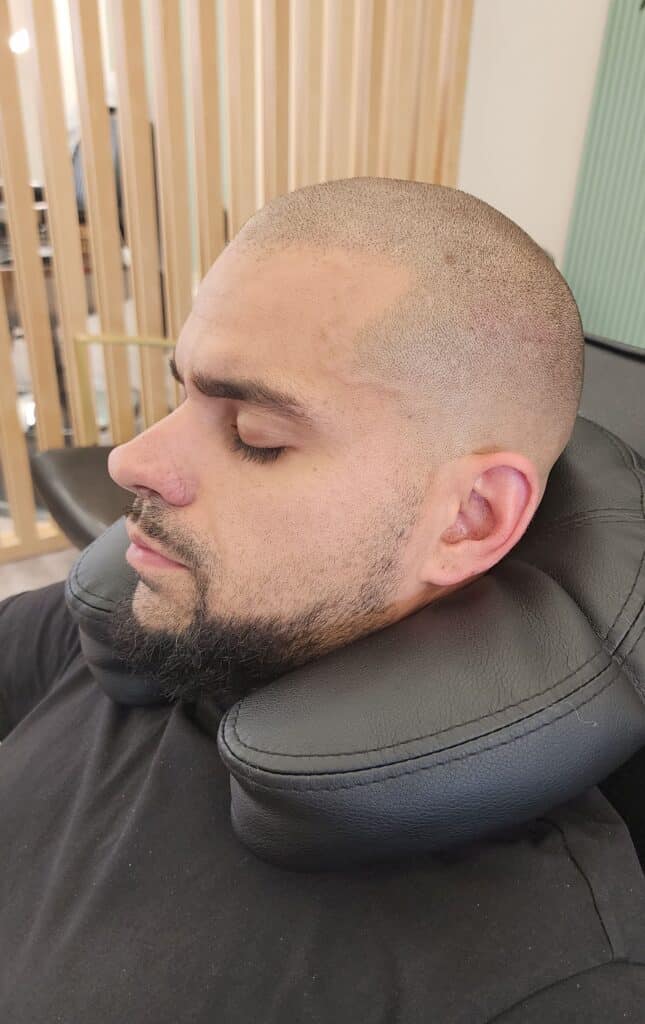 Scalp Micropigmentation, Full Scalp Micropigmentation