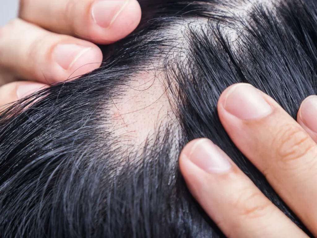 Scalp Micropigmentation, Alopecia Treatment SMP