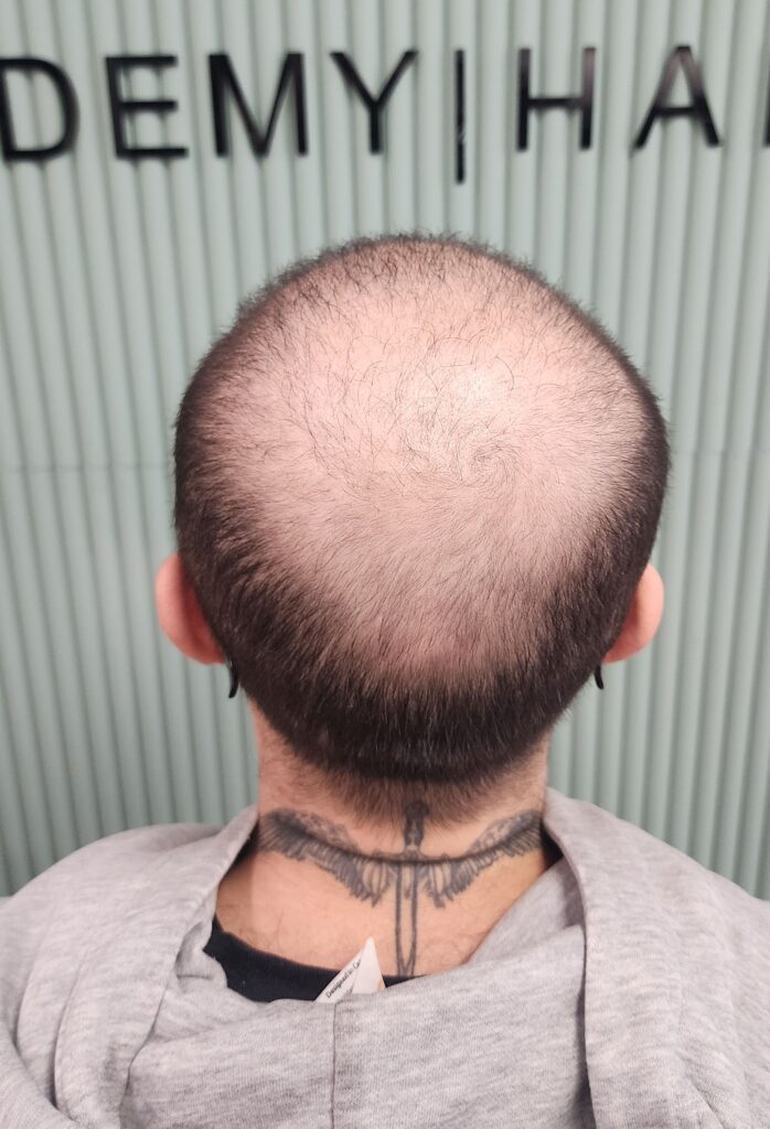 Scalp Micropigmentation, Full Scalp Micropigmentation