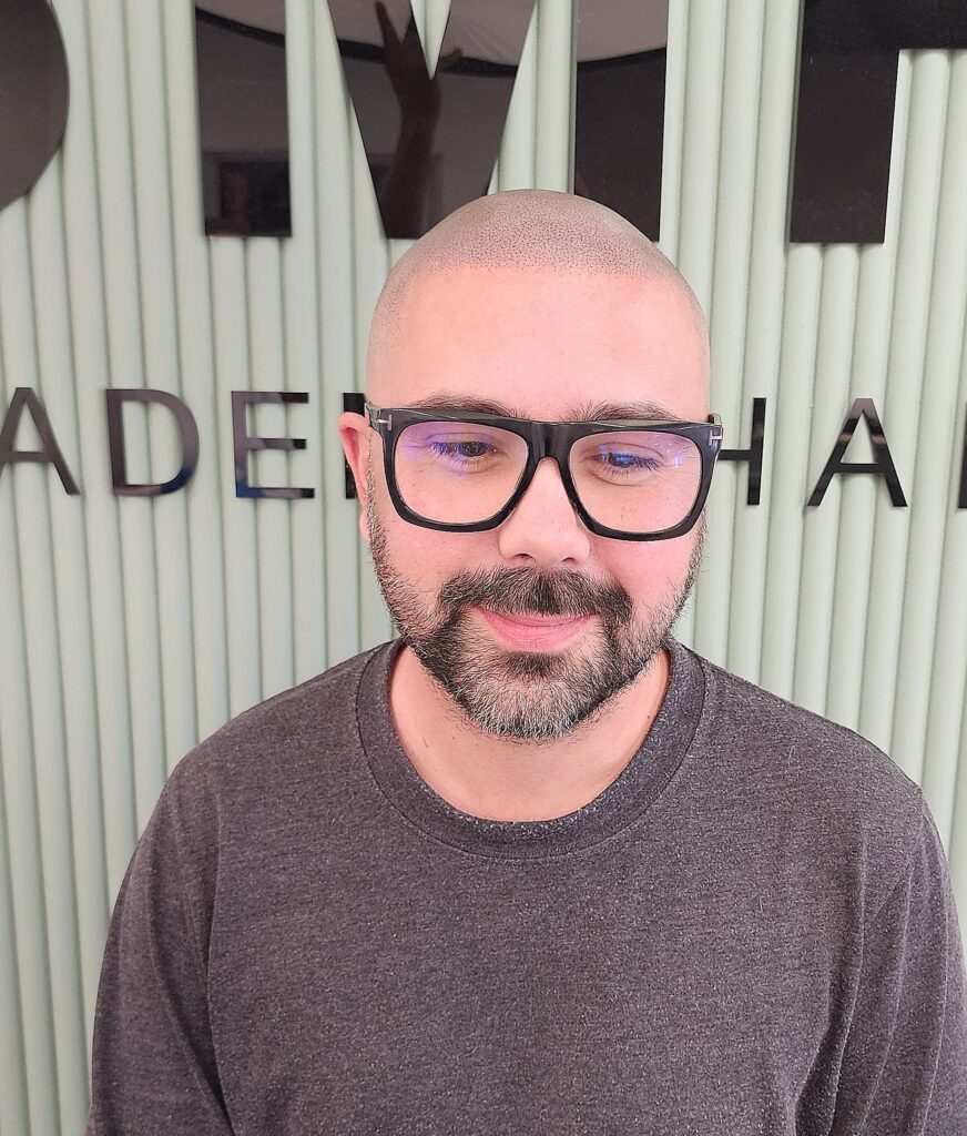 Scalp Micropigmentation, Full Scalp Micropigmentation