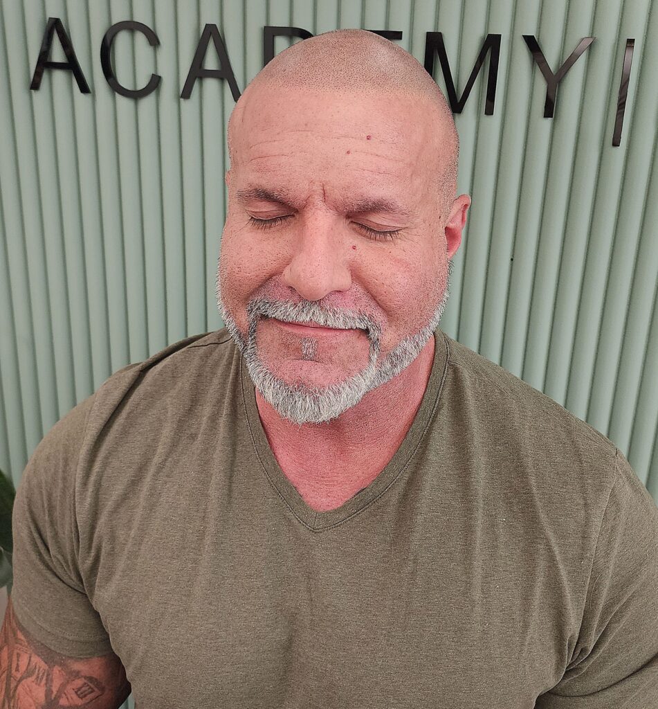 Scalp Micropigmentation, Scalp Micropigmentation in Toronto